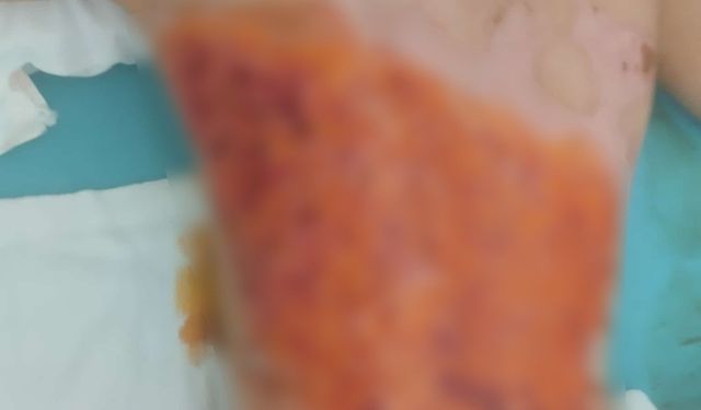 12 yaşındaki çocuğun kolonya dökülerek yakıldığı iddiası