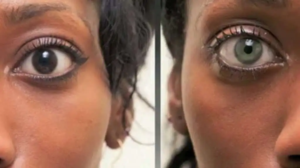 Ameliyetla Goz Rengi Degistirme